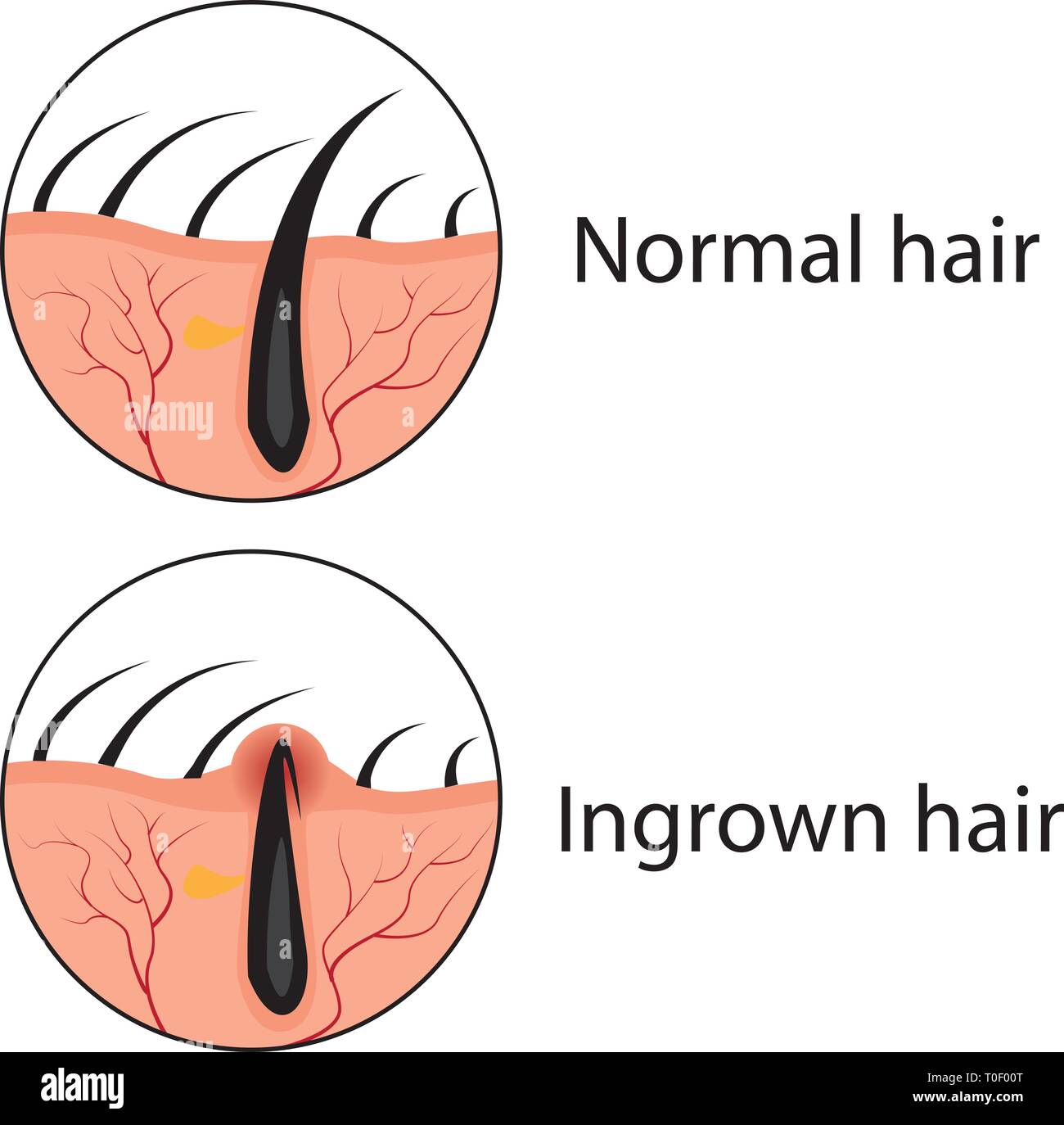 Normal und eingewachsene Haare Vector Illustration. Hautpflege Problem. Stock Vektor