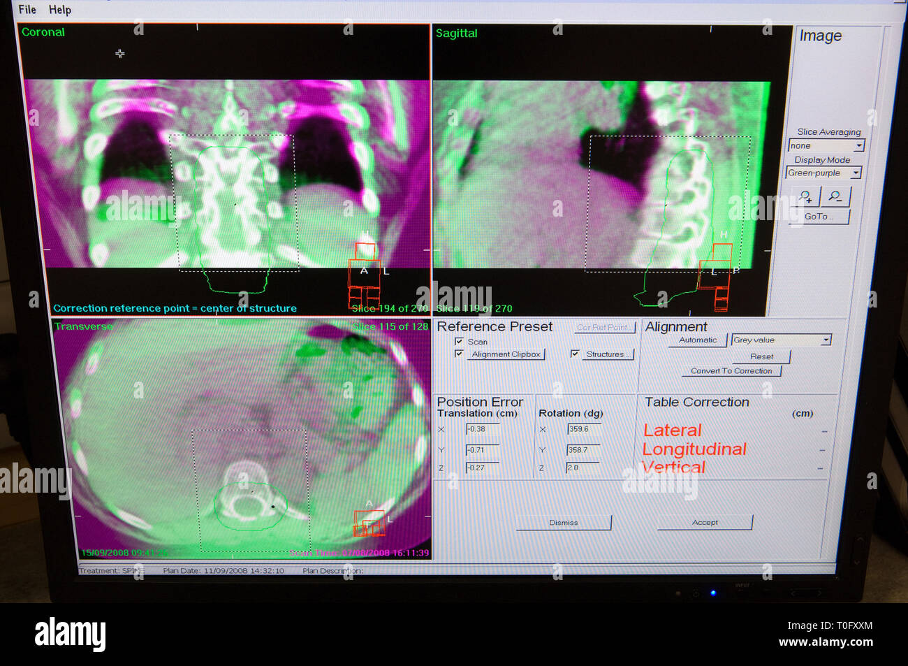 Computer Bildschirm mit Scans in der Strahlentherapie eingesetzt werden. Stockfoto