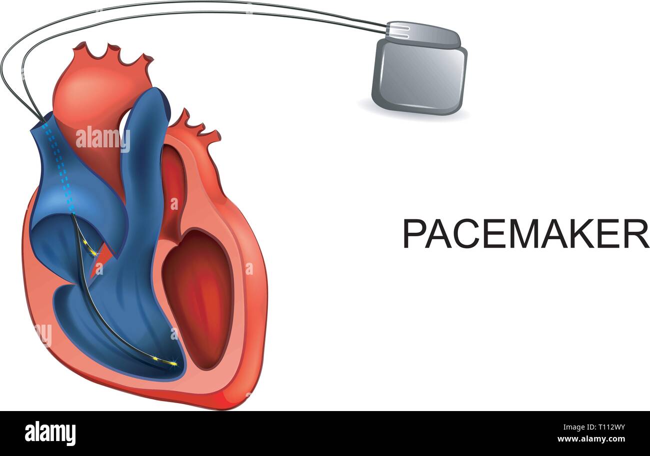 Vector Illustration des Herzens und der schrittmacher. Kardiologie Stock Vektor