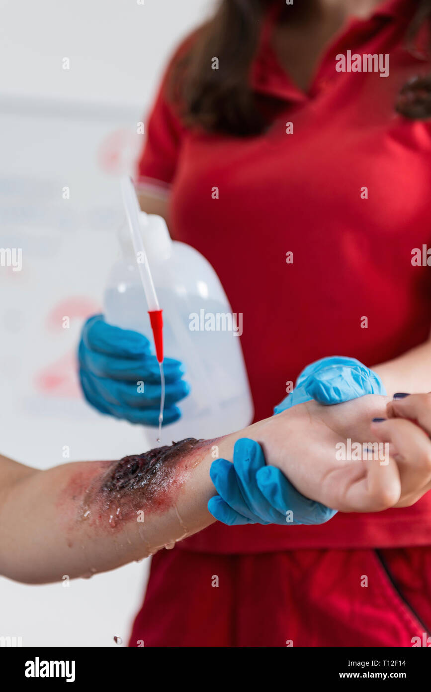 Schulung in Erster Hilfe. Brennen Sie Verletzungen. Erste Hilfe Kurs. Stockfoto