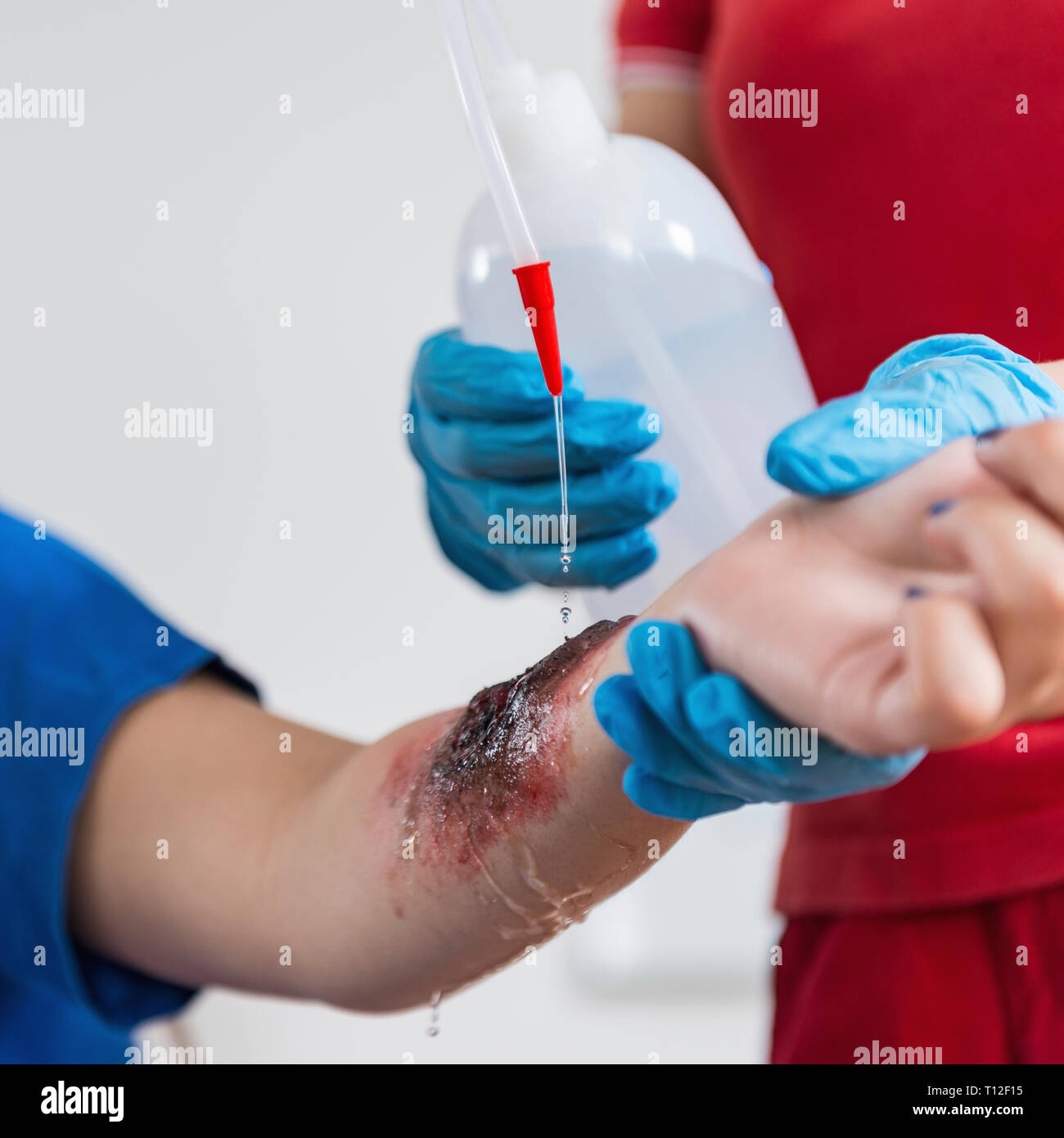 Schulung in Erster Hilfe. Brennen Sie Verletzungen. Erste Hilfe Kurs. Stockfoto