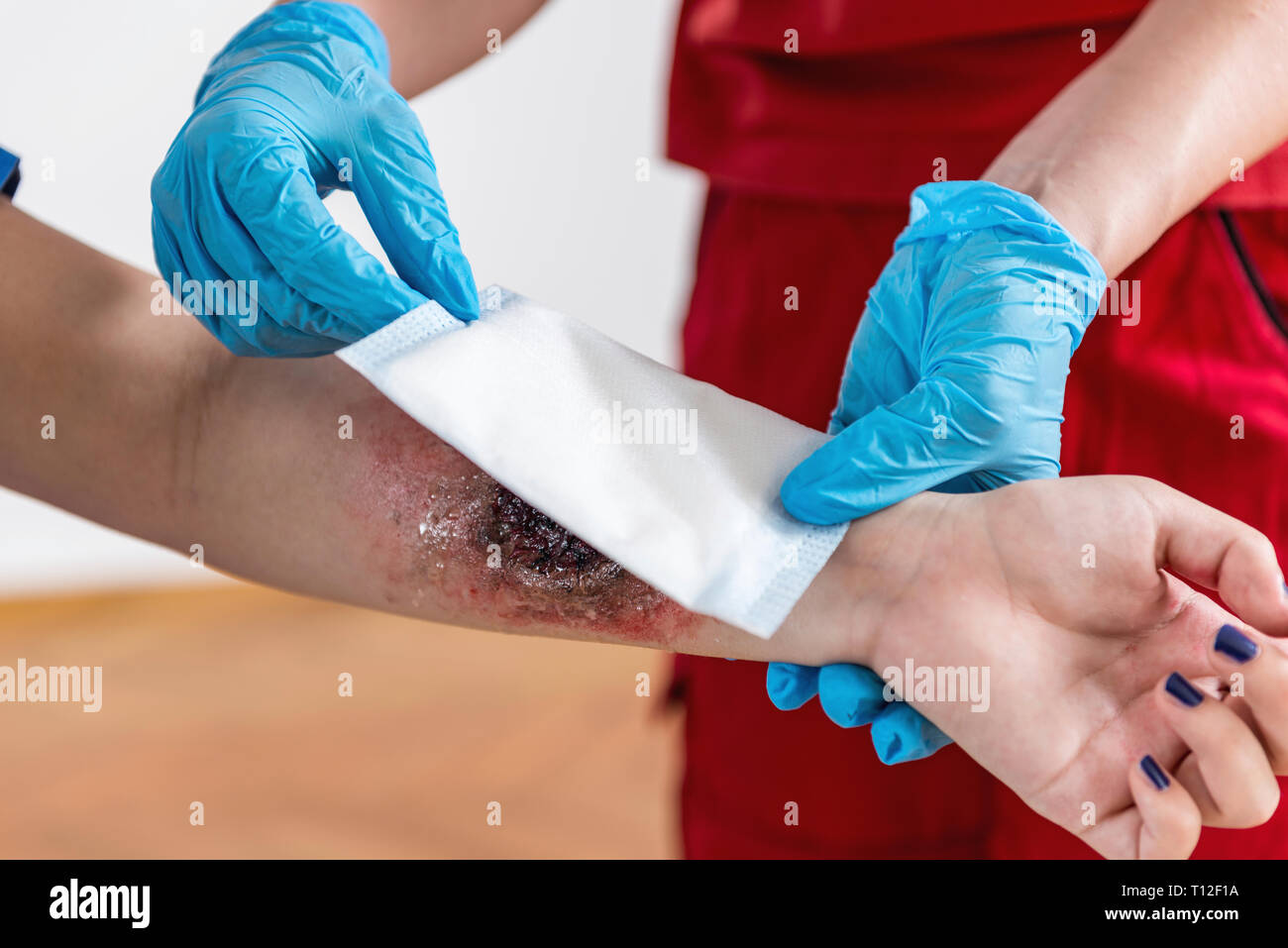 Schulung in Erster Hilfe. Brennen Sie Verletzungen. Erste Hilfe Kurs. Stockfoto