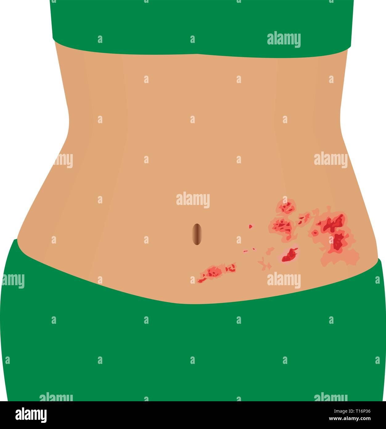 Schindeln oder Zoster am Körper einer Frau Vector Illustration