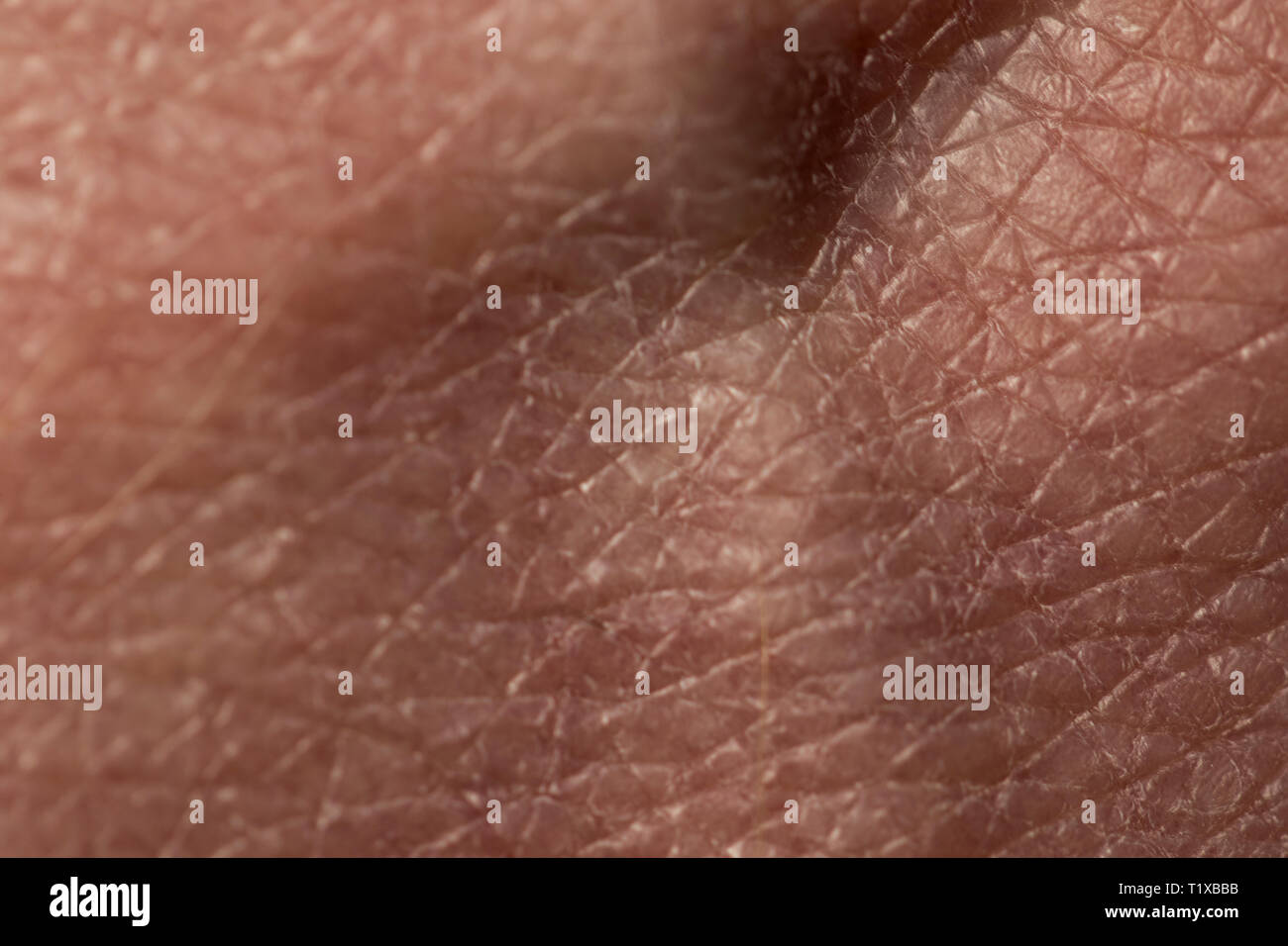 Haut ganz nah. Trocknen Sie die menschliche Haut unter dem Mikroskop mit  Ekzem beschädigt werden. Rissige, trockene Haut beschädigen Stockfotografie  - Alamy