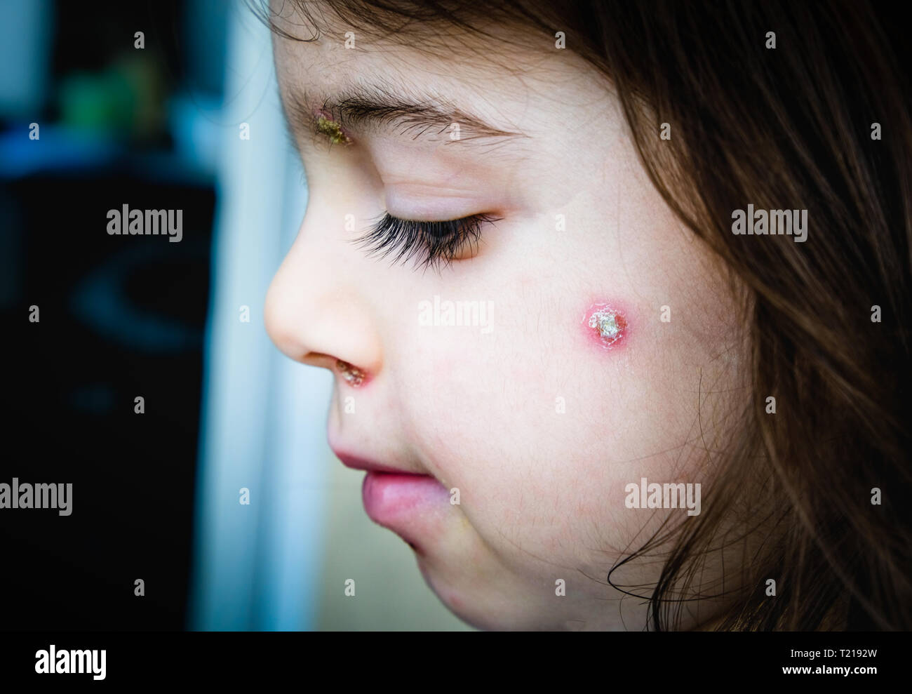 Windpocken spots Baby Gesicht seitliche Wange Stockfoto