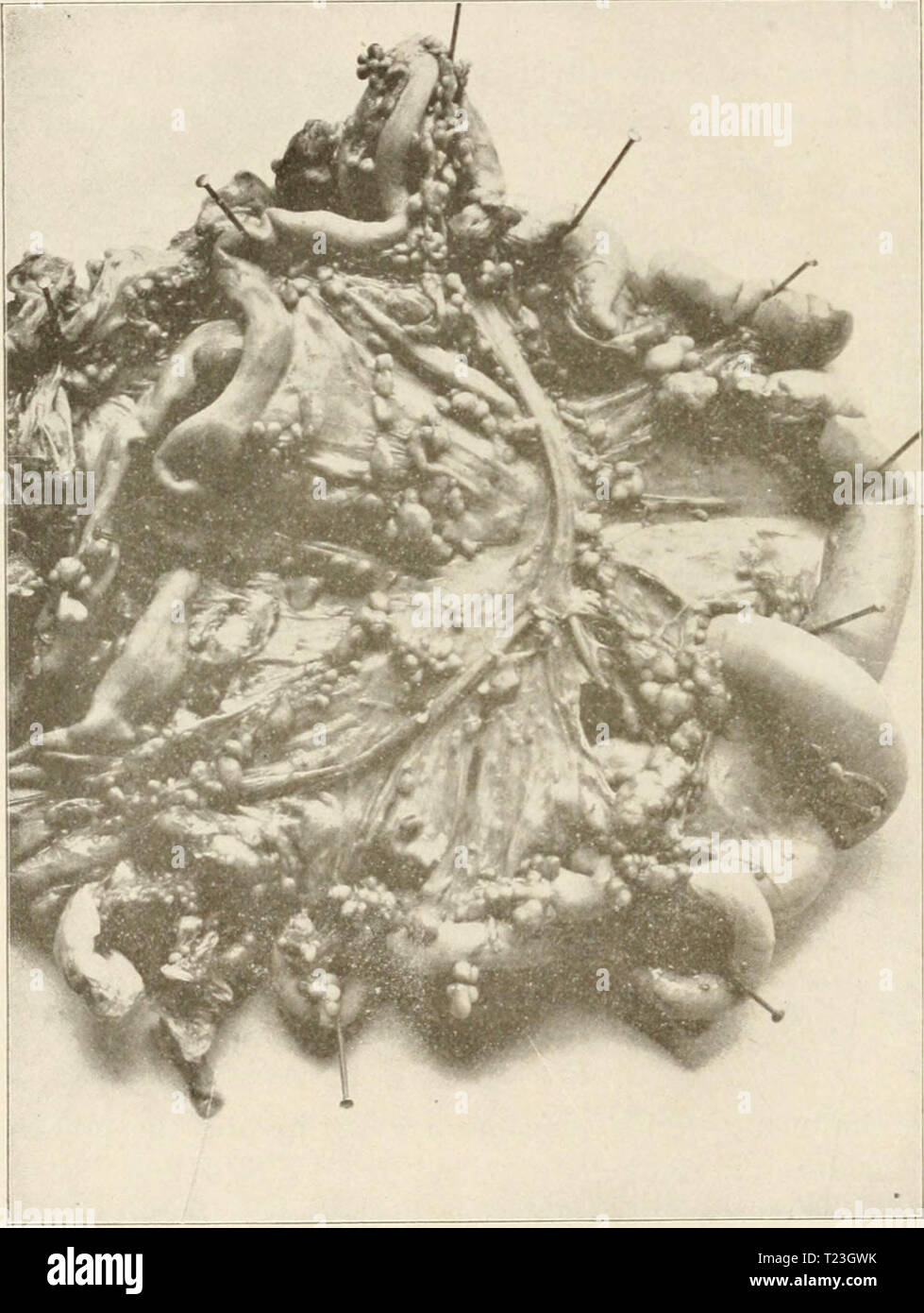 Archiv Bild ab Seite 233 Der Pathologie und Differentialdiagnose der Pathologie und differenzierte Diagnose von Infektionskrankheiten der Tiere differentpathology 00 moorrich Jahr: 1908 AVIÄRE TUBERKULOSE Zeile reaktionäre Band bestehend sehr weitgehend von runden Zellen. Die Struktur ist konstant, sowohl im kleinen als auch im großen tuberkel, und nicht auffallend anders von der Struktur der tuberkel in Abb. 49. Ein Foto von einer Tuberkulösen mesenterium eines foTcl. sind ein paar kleine Tuberkel auf den Darm. Es bestimmte der Säugetiere. Die größeren Knoten scheint in einigen Fällen das Ergebnis einer Fortsetzung zu sein Stockfoto