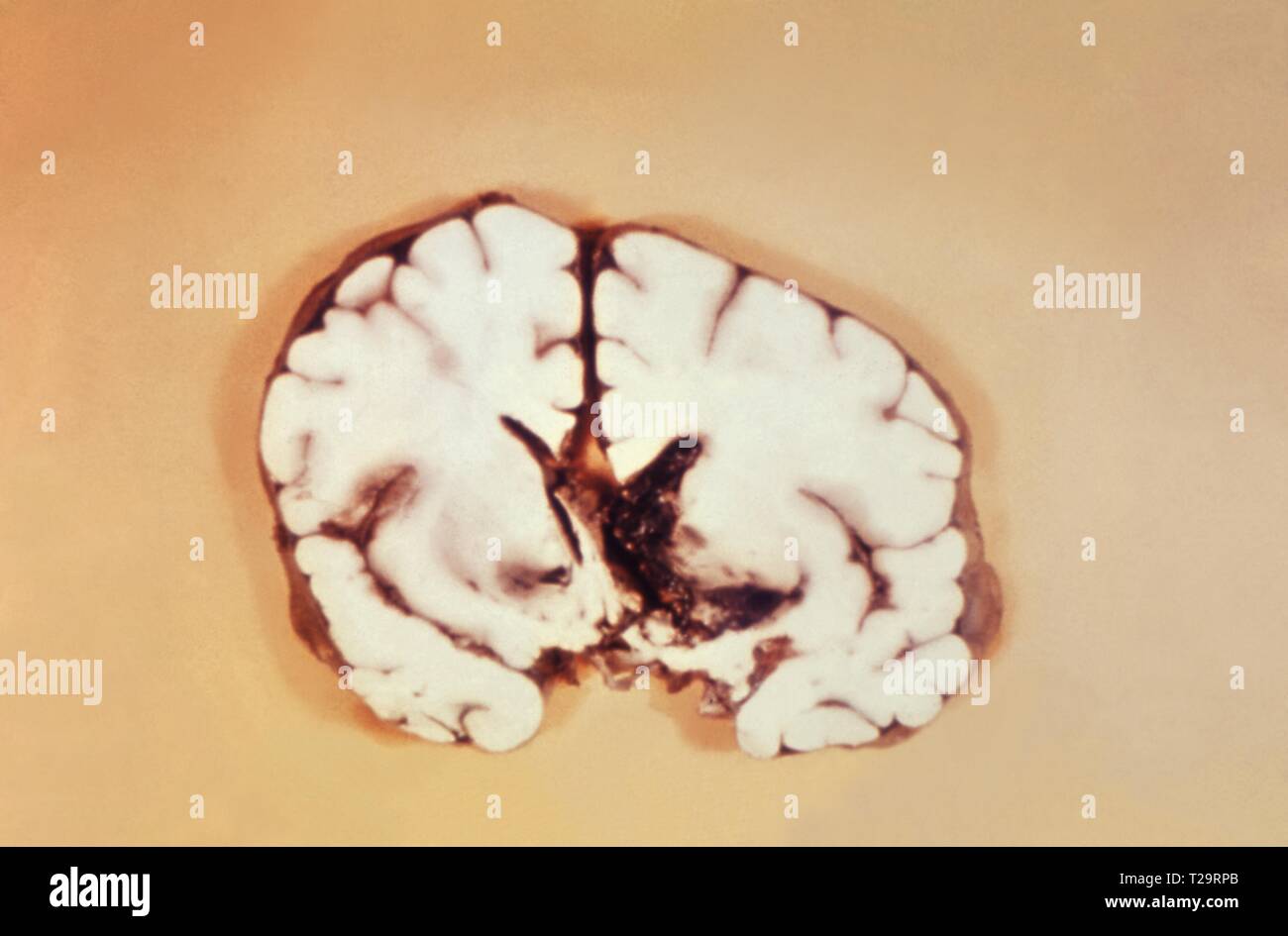 Nahaufnahme der Gehirnhälfte mit Interventrikuläre Blutung durch Milzbrand Meningitis, 1966 verursacht. Bild mit freundlicher Genehmigung Zentren für Krankheitskontrolle und Prävention (CDC). () Stockfoto