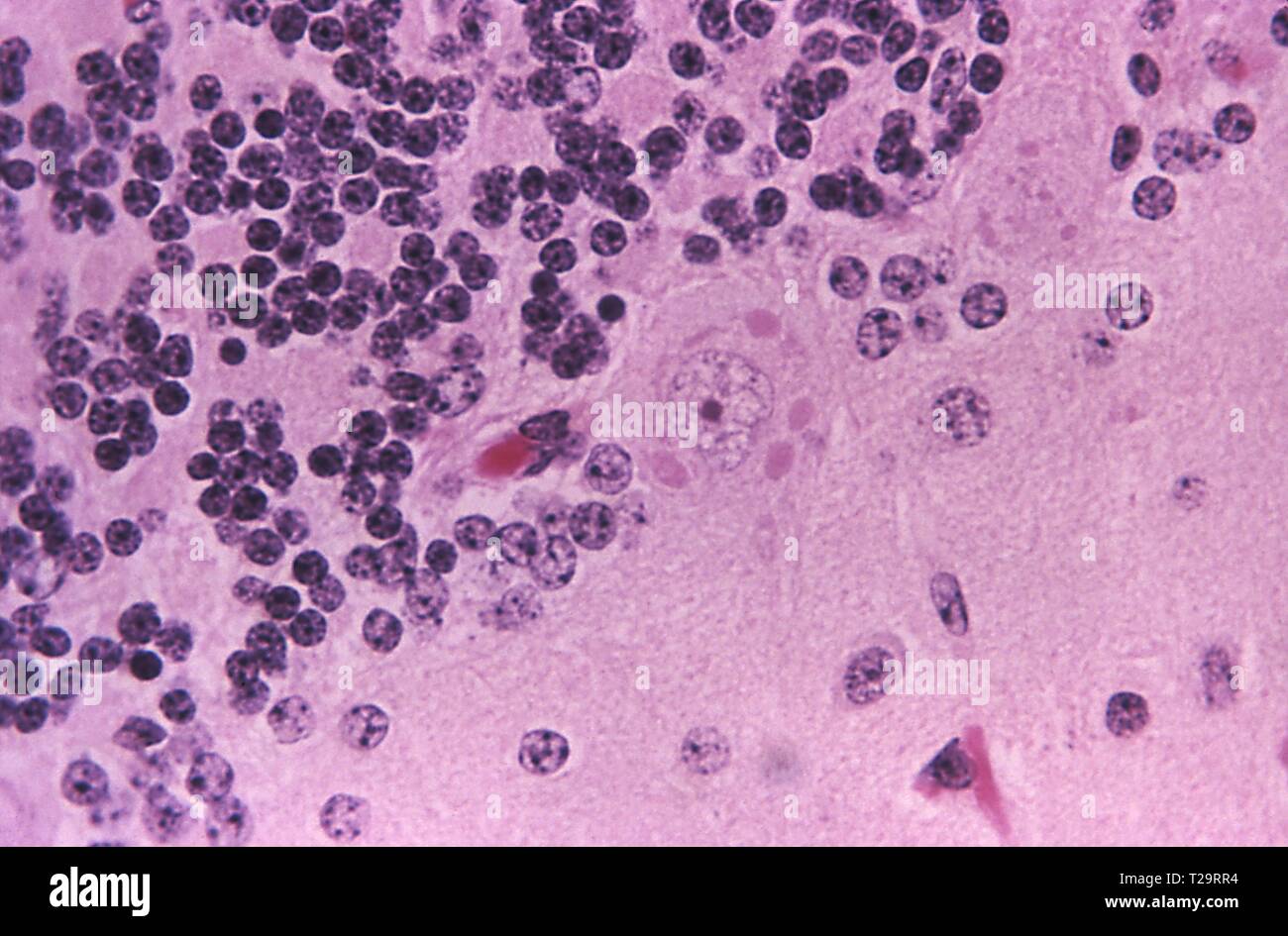 Hämatoxylin - eosin gebeizt photomicrograph der zellulären Veränderungen mit Tollwut Enzephalitis, 1971 verbunden. Bild mit freundlicher Genehmigung Zentren für Krankheitskontrolle und Prävention (CDC)/Dr Daniel S. Perl. () Stockfoto