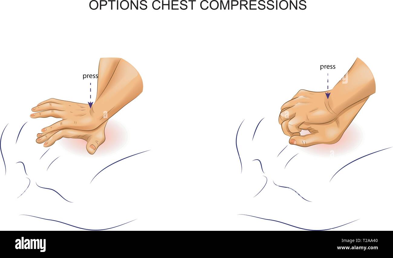 Vector Illustration indirekter Herzmassage Optionen Stock Vektor