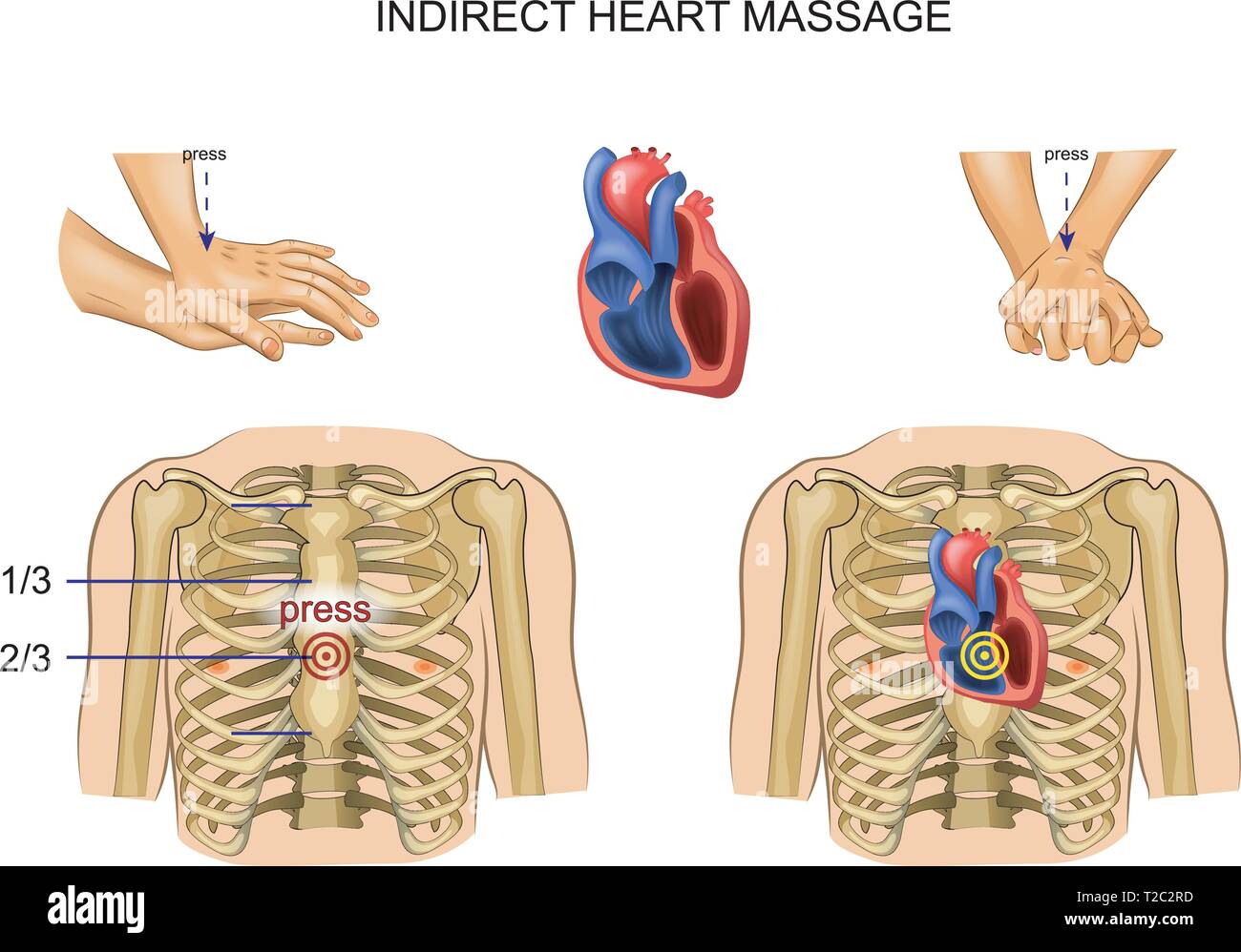 Vector Illustration indirekter Herzmassage. Verordnung Stock Vektor