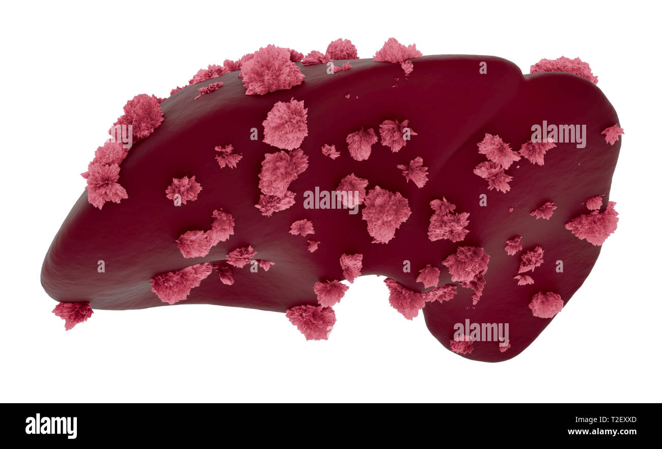 Das hepatozelluläre Karzinom (HCC) oder Malignen (bösartigen) Knötchen auf eine Leber. Die medizinische Wissenschaft und Forschung Konzept Stockfoto
