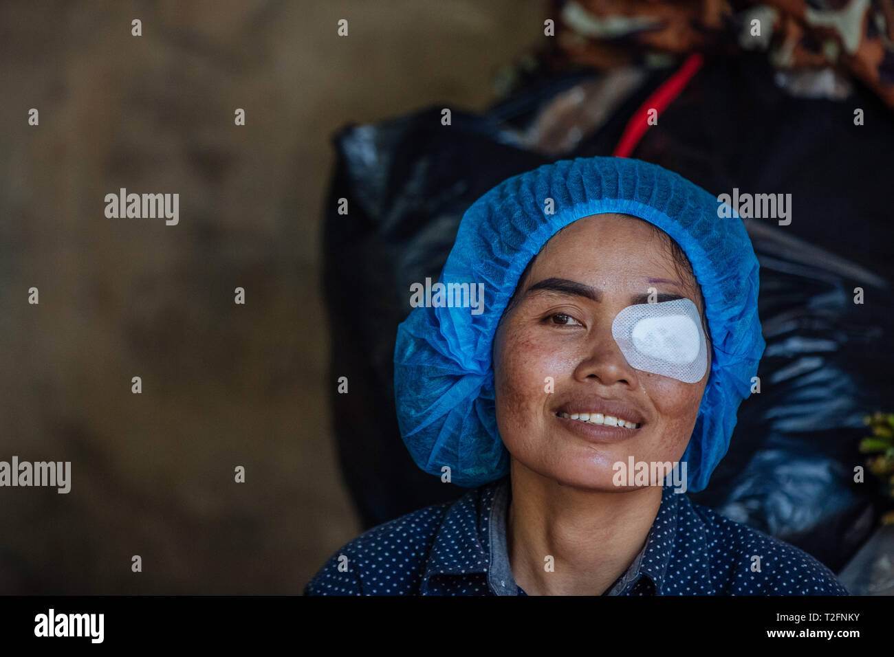 (190402) - PHNOM PENH, 2. April 2019 (Xinhua) - Summe Meyle nimmt einen Rest nach einer Operation im Krankenhaus in der Provinz Kampong Cham Kampong Cham, Kambodscha, 15. März 2019. Summe Meyle, 36, ist alleinerziehende Mutter mit 5 Kindern. Um zu helfen, ihre finanziellen Bedingungen, zwei von meyle's Töchter jetzt Arbeiten in der Hauptstadt Phnom Penh, während zwei ihrer Söhne leben in einem Pflegeheim zu verbessern. Meyle lebt jetzt in einem gemieteten shanty Haus mit ihrer jüngsten Tochter. Meyle von Katarakt erlitten, nachdem ihr linkes Auge verletzt wurde. Vor sieben Monaten hatte sie fast ihr Auge verloren Stockfoto
