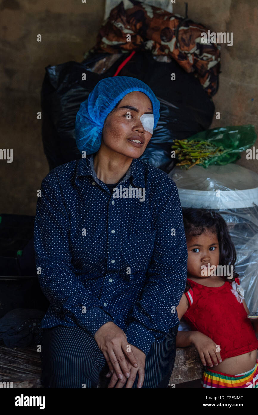 (190402) - PHNOM PENH, 2. April 2019 (Xinhua) - Summe Meyle nimmt einen Rest mit ihrer Tochter nach einer Operation im Krankenhaus in der Provinz Kampong Cham Kampong Cham, Kambodscha, 15. März 2019. Summe Meyle, 36, ist alleinerziehende Mutter mit 5 Kindern. Um zu helfen, ihre finanziellen Bedingungen, zwei von meyle's Töchter jetzt Arbeiten in der Hauptstadt Phnom Penh, während zwei ihrer Söhne leben in einem Pflegeheim zu verbessern. Meyle lebt jetzt in einem gemieteten shanty Haus mit ihrer jüngsten Tochter. Meyle von Katarakt erlitten, nachdem ihr linkes Auge verletzt wurde. Vor sieben Monaten hatte sie ein Stockfoto