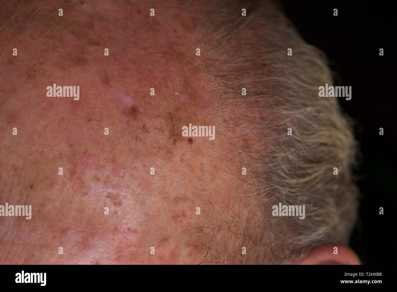 Karzinom Melanom der Haut Schaden auf ältere mans Stirn durch die Sonne. Nahaufnahme von Krebsvorstufen der Haut. Stockfoto