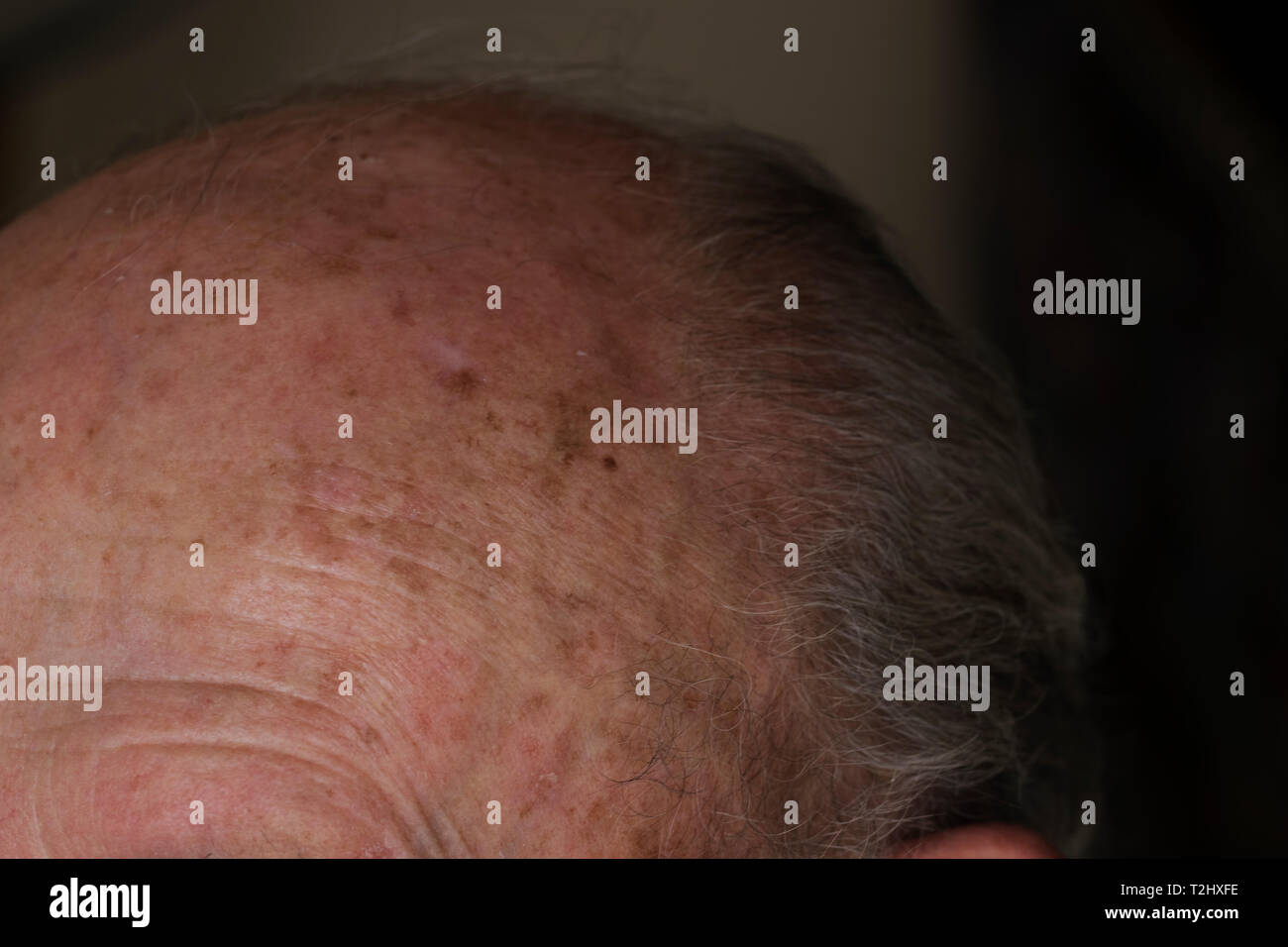 Nahaufnahme der prekanzerösen beschädigte Haut von der Sonne verursacht. Melanom auf der Stirn eines älteren Mannes. Stockfoto