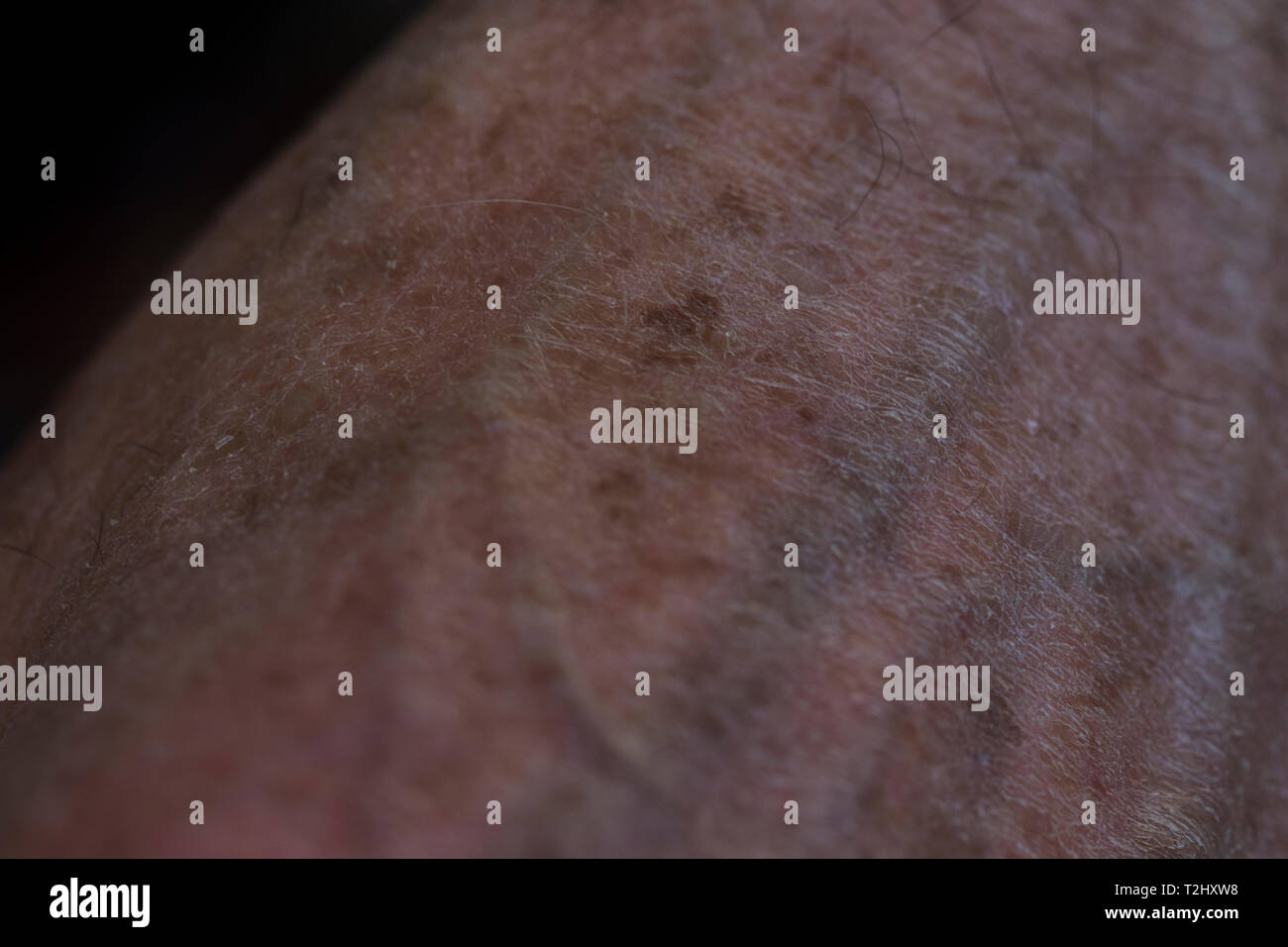 Hand mit Haut Schaden von Alter und sun Trauma. In der Nähe der Leber Flecken auf ältere mans Hände. Stockfoto