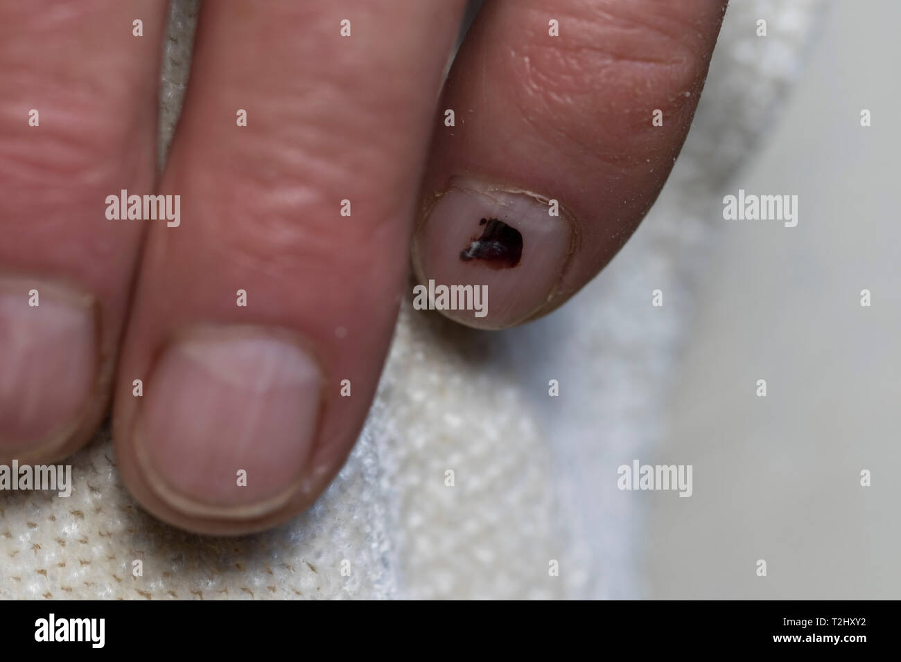 Subunguales Hamatom Stockfotos Und Bilder Kaufen Alamy