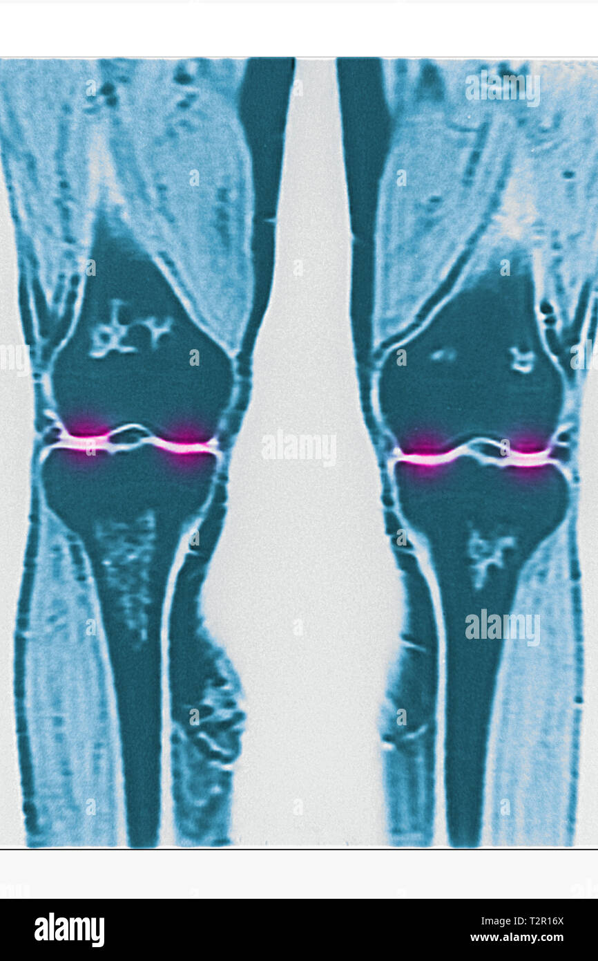 Arthritis Stockfoto