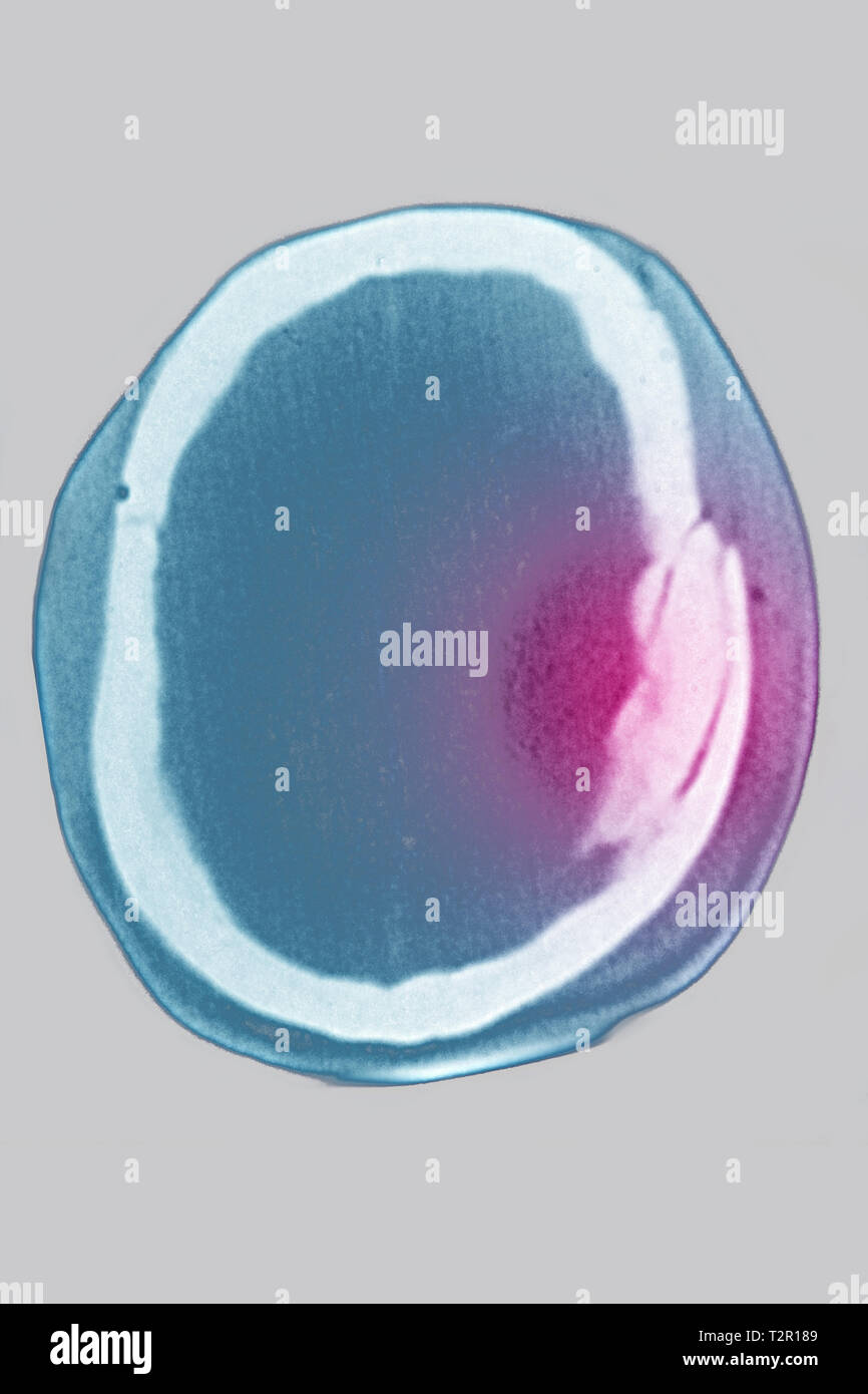 Bruch des Schädels Stockfoto