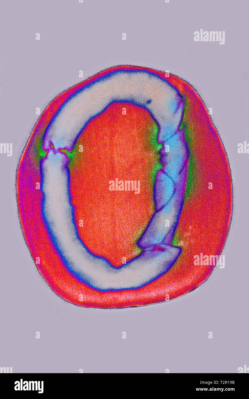 Bruch des Schädels Stockfoto
