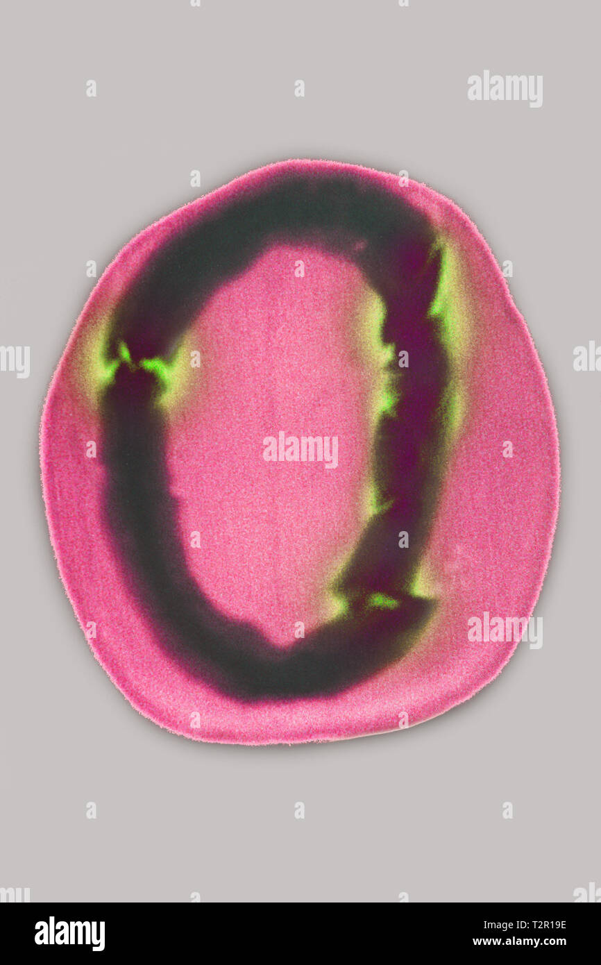 Bruch des Schädels Stockfoto