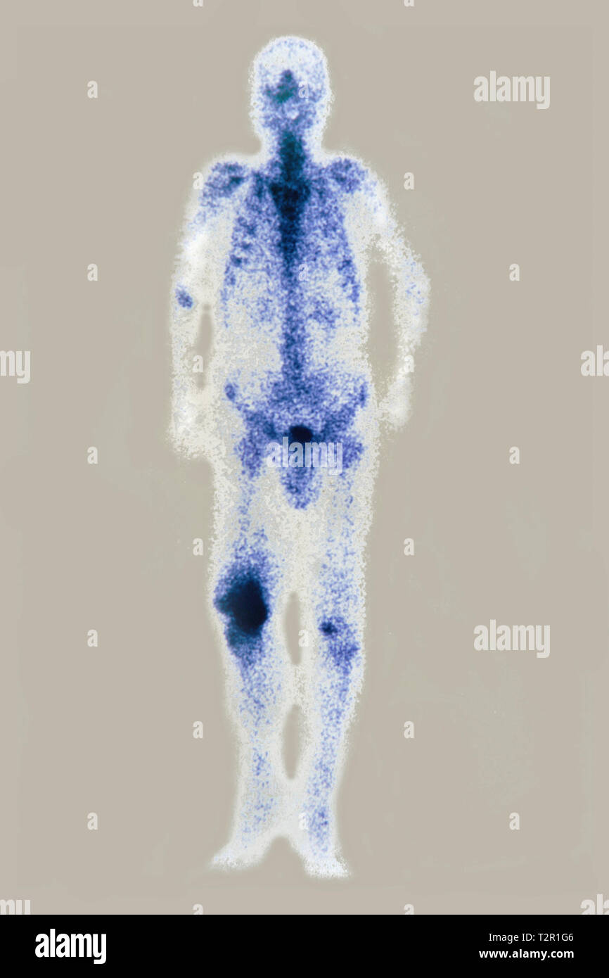 Osteosarkom Stockfoto