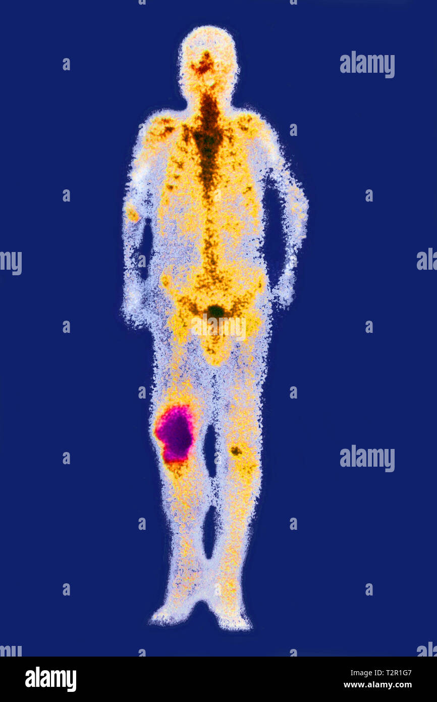 Osteosarkom Stockfoto