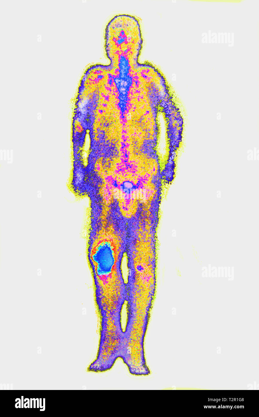 Osteosarkom Stockfoto