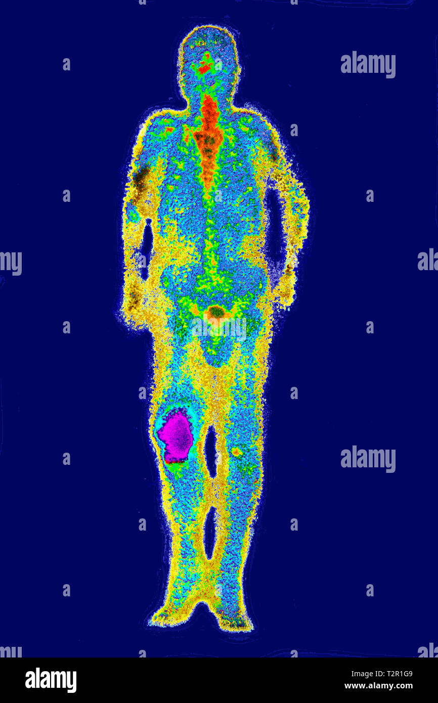 Osteosarkom Stockfoto