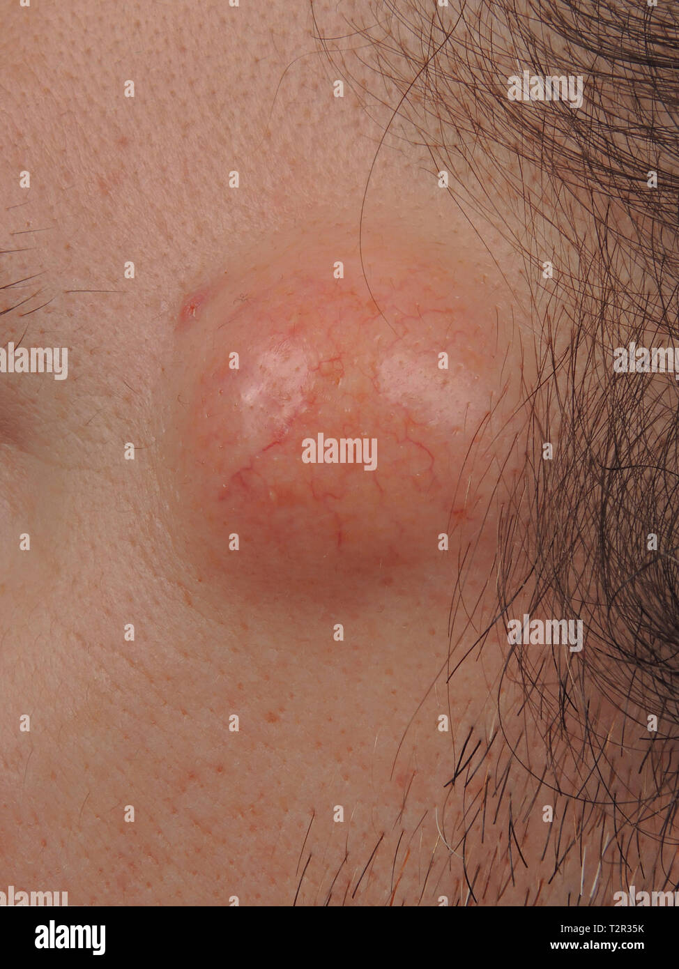 epidermale zyste