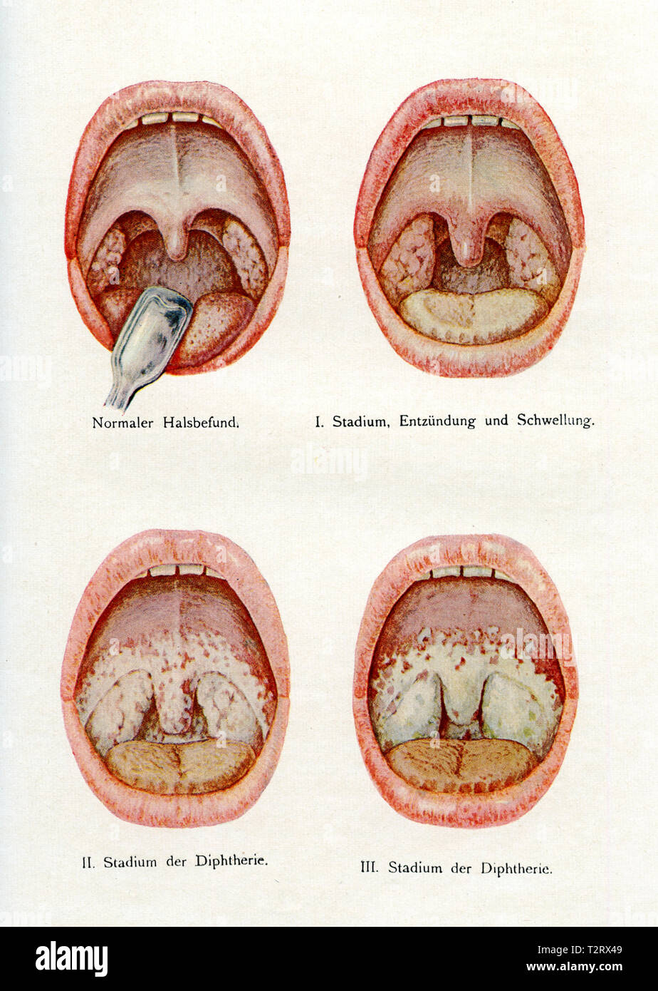 Diphterie Symptome in den Mund, 1900 Stockfoto