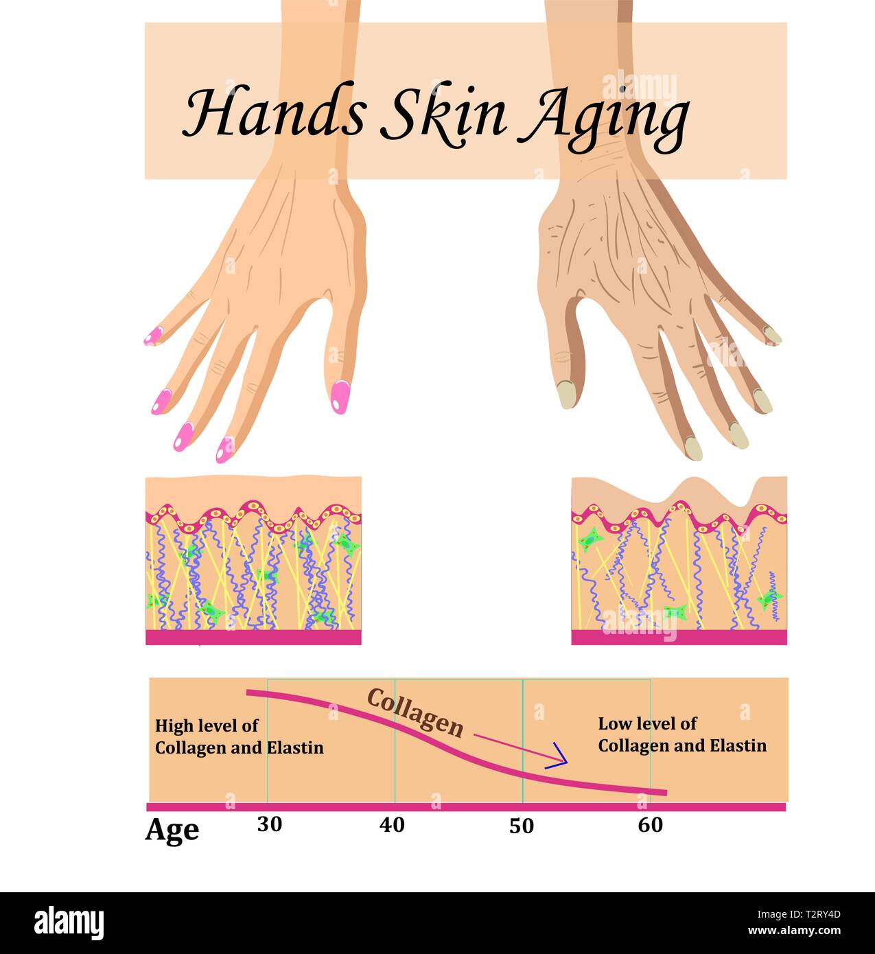 Hände Haut altern, infografik Vector Illustration mit einem Diagramm Stock Vektor