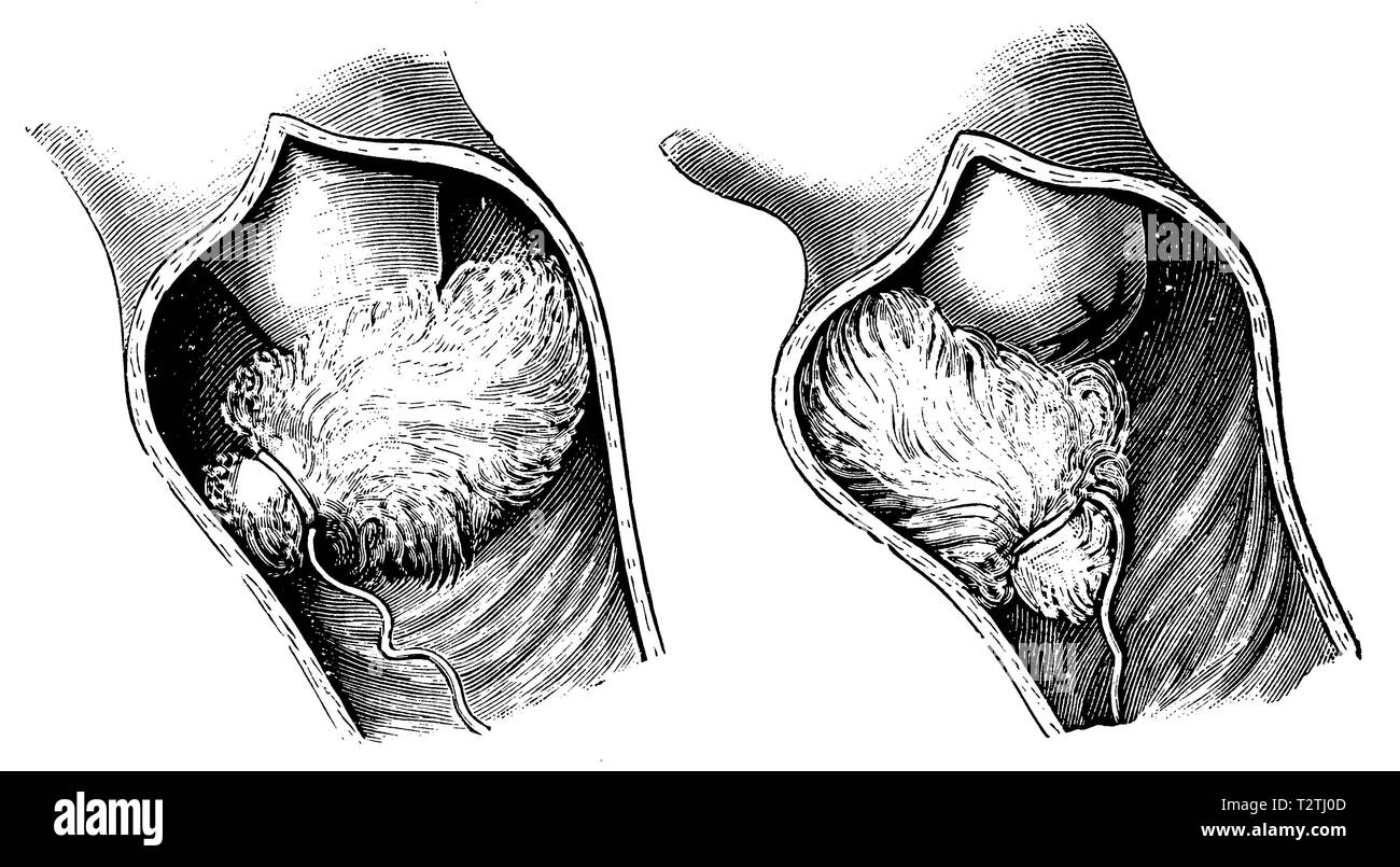 Empfängnisverhütung mit Hilfe eines Watte getränkt in Essig. Korrekte Position der Wattebausch (links). Falsche Lage der Wattebausch (rechts), 1905 Stockfoto