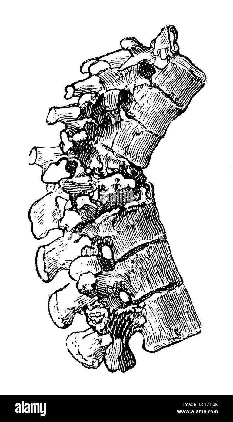 Tuberkulose der Wirbelsäule, 1905 Stockfoto