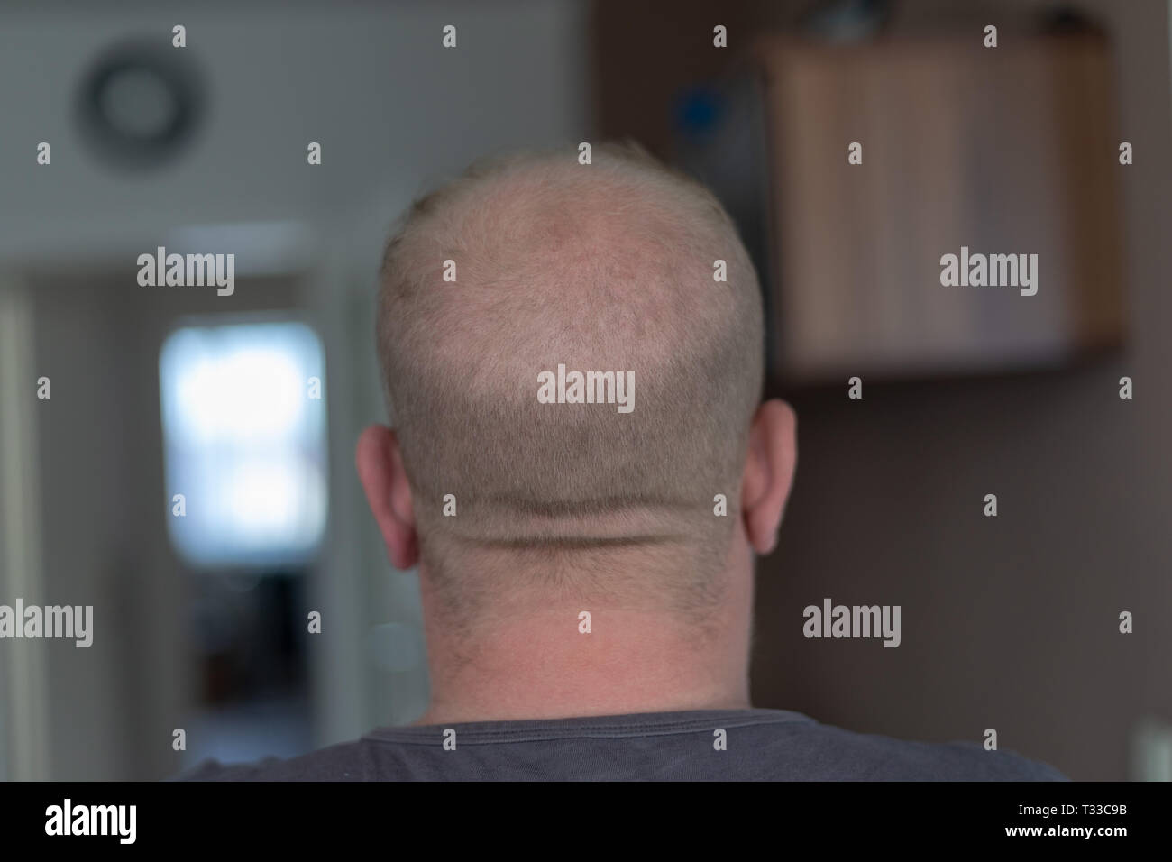 Menschliche Alopezie oder Haarausfall - erwachsene Männer Glatze Stockfoto