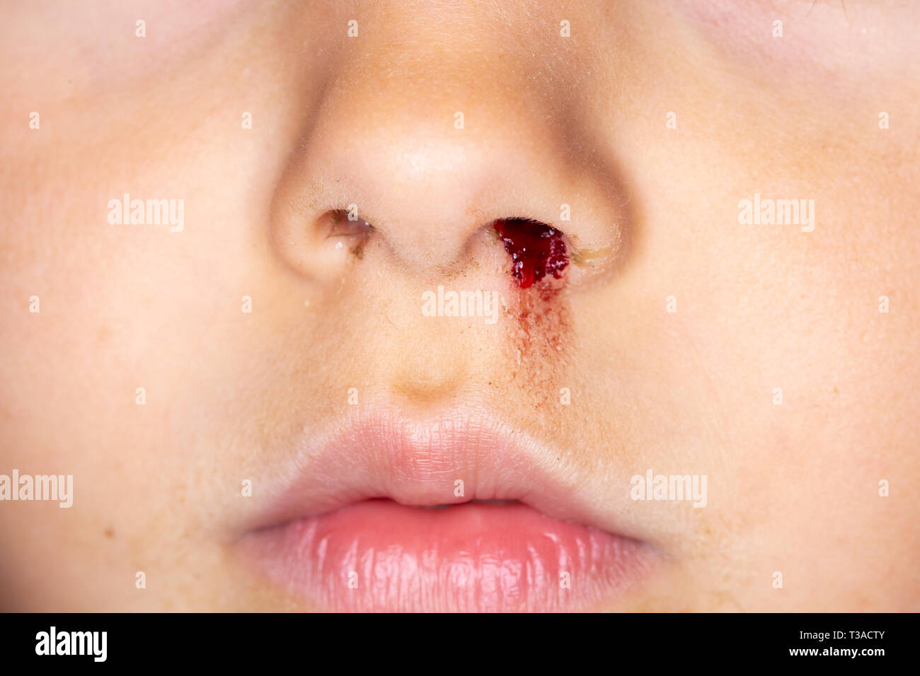 Nahaufnahme eines kleinen kaukasischen Kind mit einer blutenden Nase Stockfoto