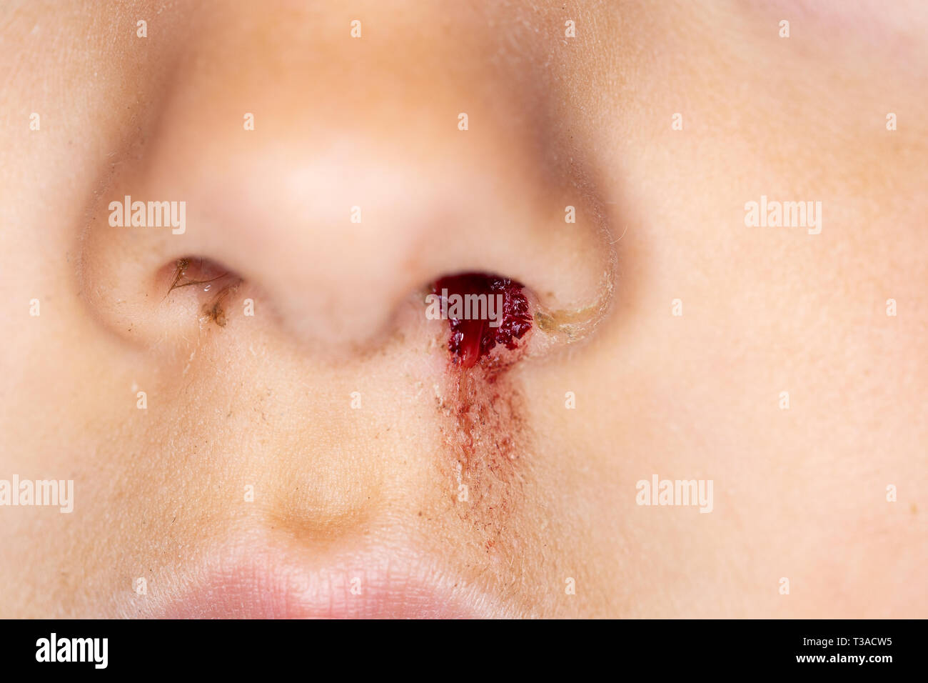Nahaufnahme eines kleinen kaukasischen Kind mit einer blutenden Nase Stockfoto