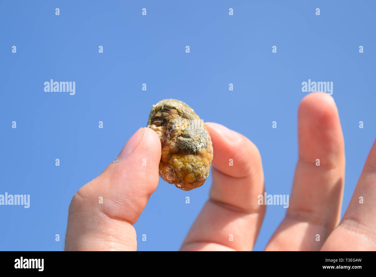 Stein der Gallenblase. Das Ergebnis von Gallensteinen. Ein Kalkül der heterogenen Zusammensetzung vor blauem Himmel. Stockfoto