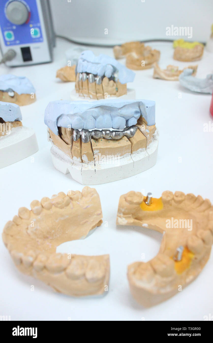 Keramische Kronen mit Implantaten in einem Labor Stockfoto