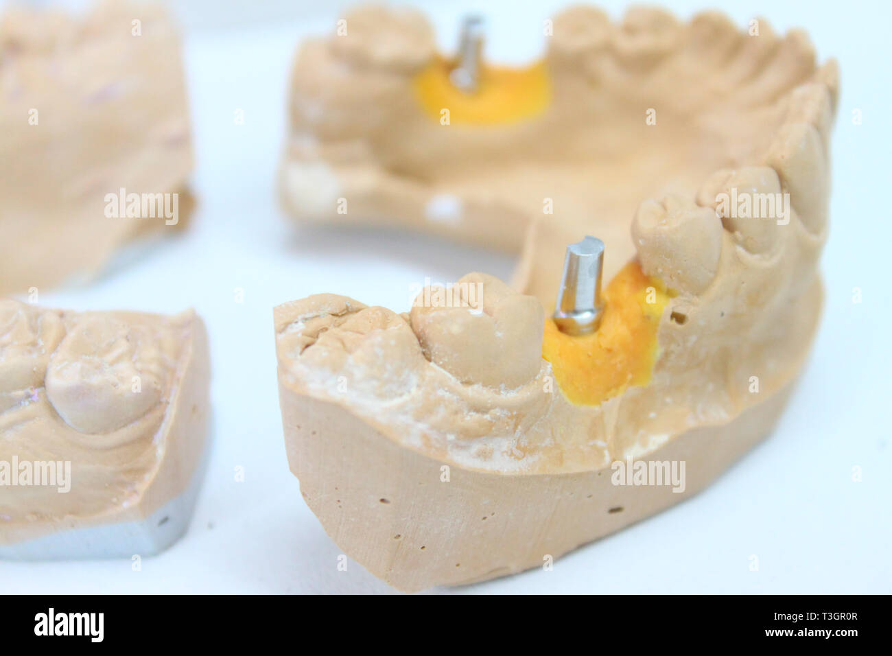 Keramische Kronen mit Implantaten in einem Labor Stockfoto