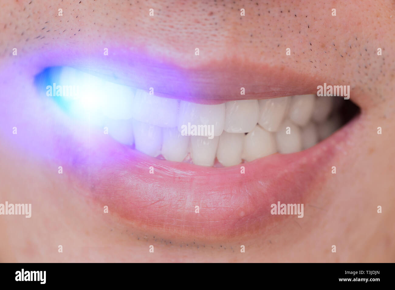 Blaue LED Laser Licht bleichen Zähne, die zahnärztliche Behandlung Konzept. Stockfoto