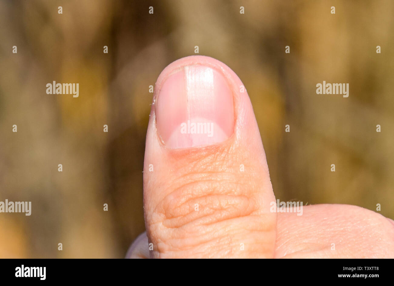 Gespaltener Nagel Am Daumen Dilatation Des Nagels Traumatische Pathologie Der Nagel Ist In Zwei Halften Geteilt Stockfoto Und Mehr Bilder Von Blauer Fleck Istock