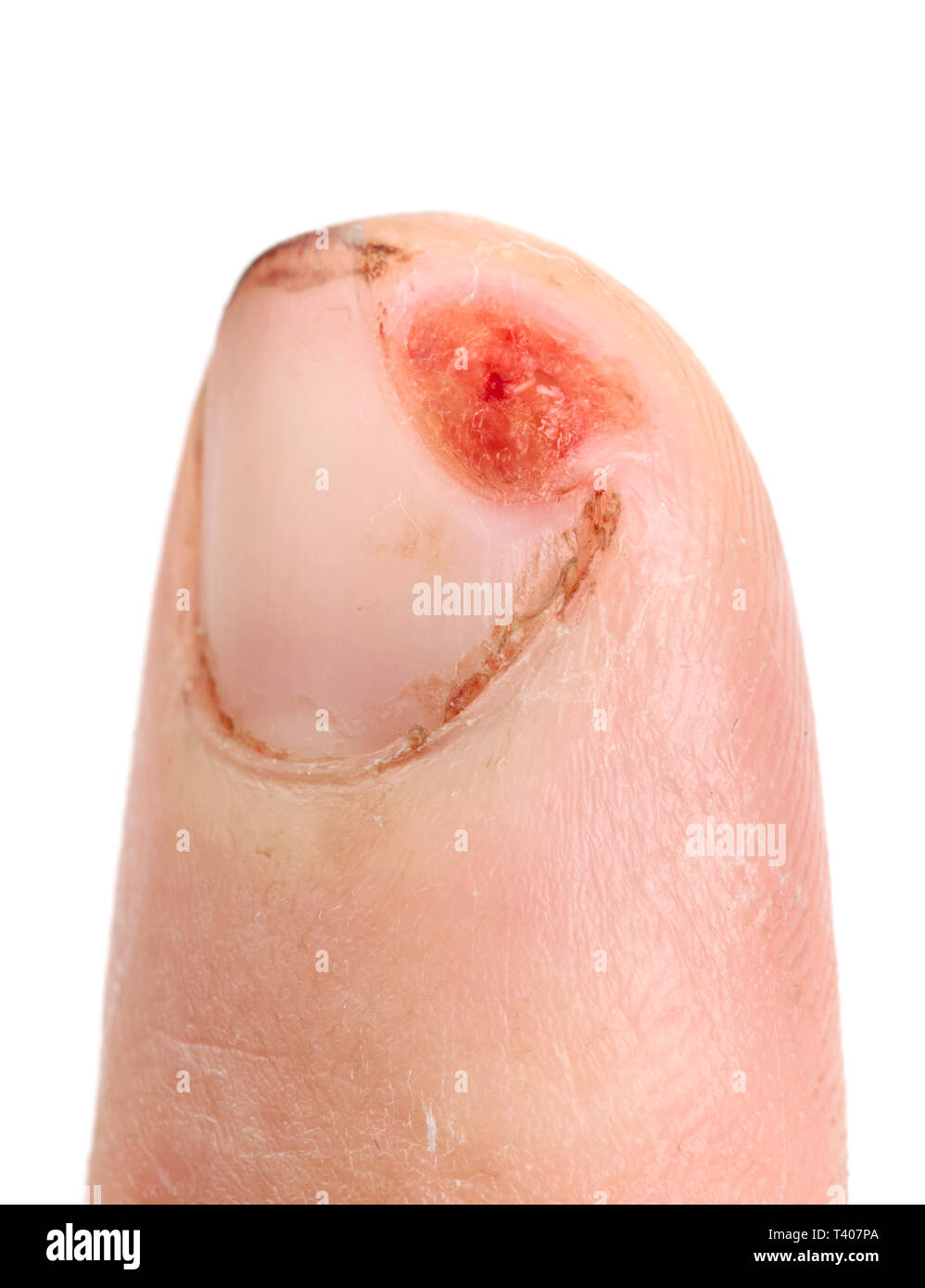 Finger geschnitten mit Messer, nicht imitiert, 5 Tag nach Verletzungen, makroaufnahme auf weißem Hintergrund Stockfoto