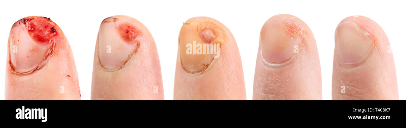 Heilung von cut Finger, das hat ungefähr einen Monat, isoliert, 45 Megapixel Größe Stockfoto