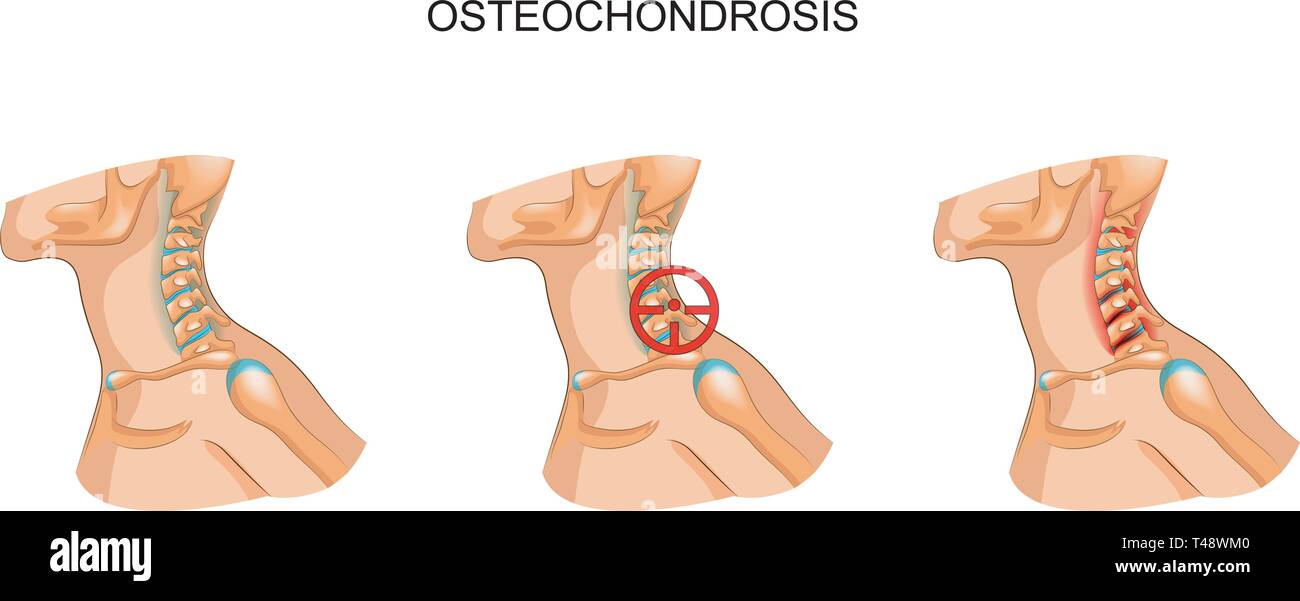 Vector Illustration der Osteochondrose der Halswirbelsäule Stock Vektor