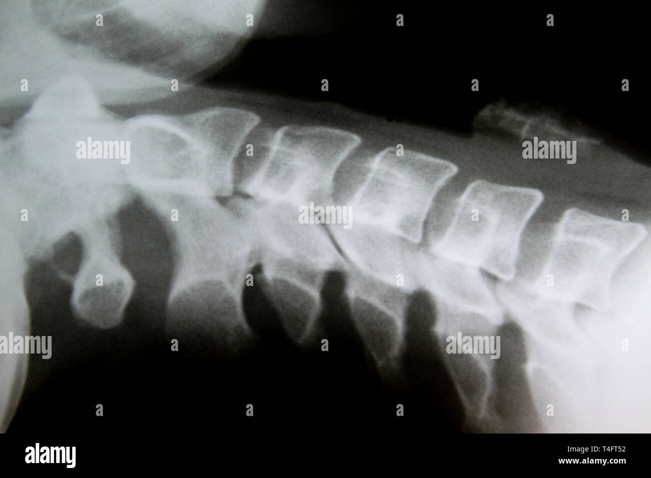 X-Ray Image der gesunden regelmäßigen Halswirbelsäule (negative Ergebnisse) Stockfoto