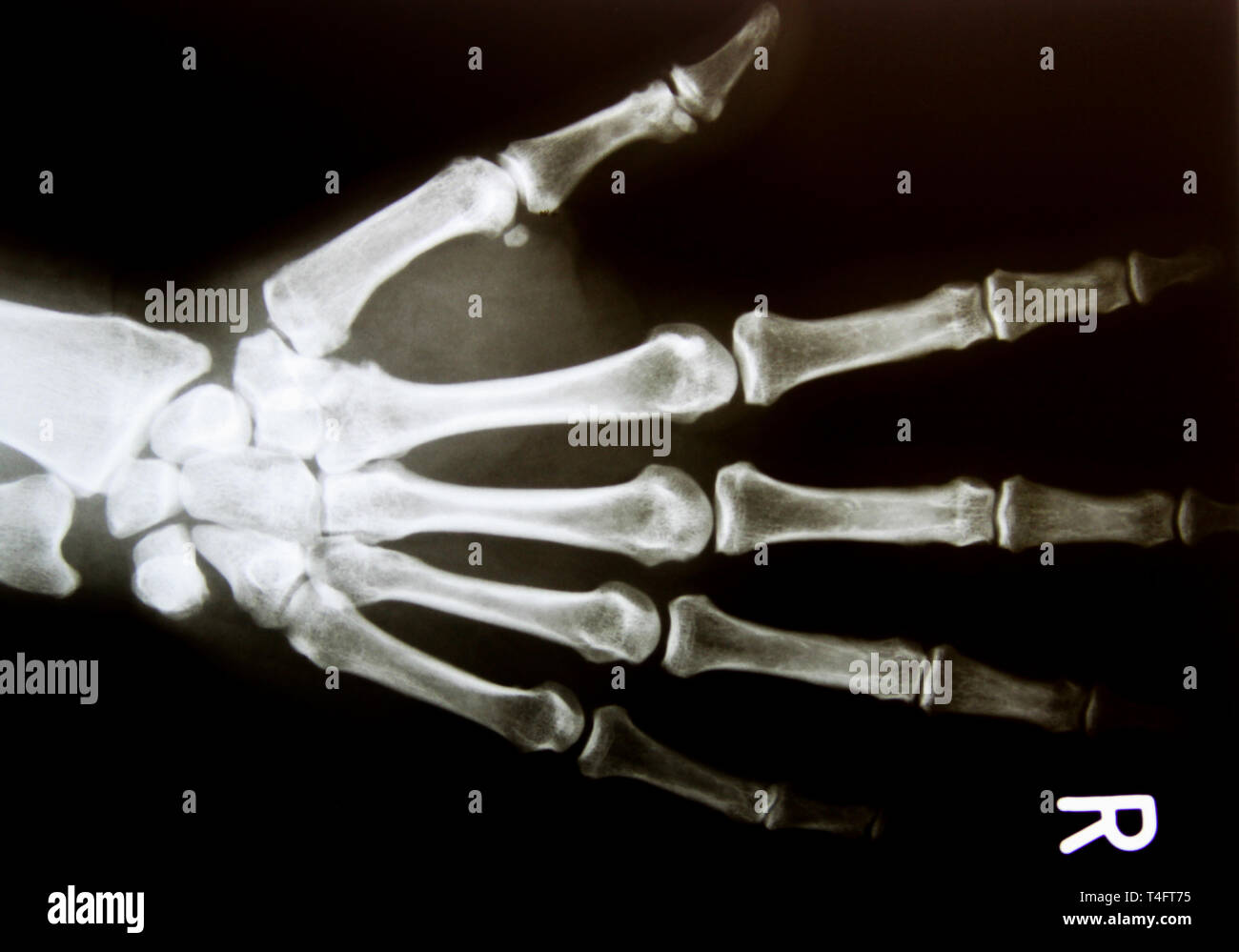X-ray Image der gesunden normalen menschlichen Hand Stockfoto