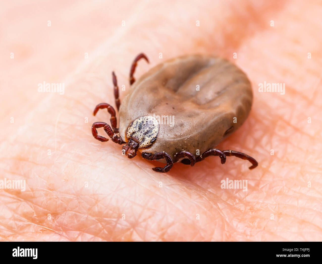Enzephalitis Virus oder Lyme Krankheit oder Affe Fieber angesteckt Dermacentor Zecke Spinne Insekt auf der Haut Stockfoto