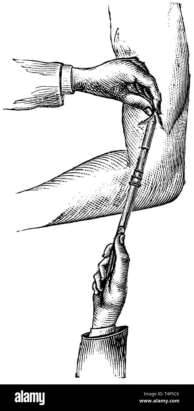 Morphium Spritzen unter die Haut mit Patent Leiter der Spritze, anonym 1887  Stockfotografie - Alamy