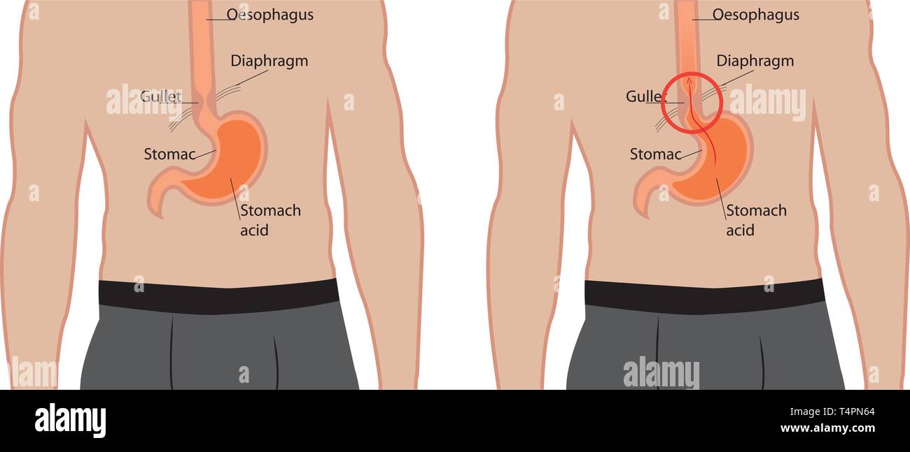 Gastroösophagealer Reflux Krankheit. Gerd Magen in einem menschlichen Körper Vector Illustration auf weißem Hintergrund Stock Vektor